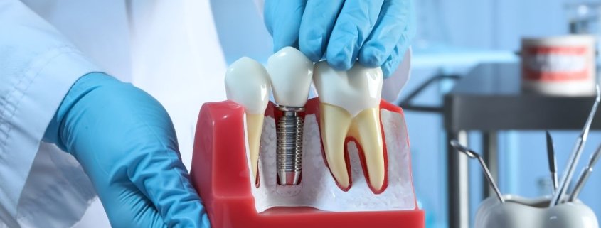 cuidar tus implantes dentales